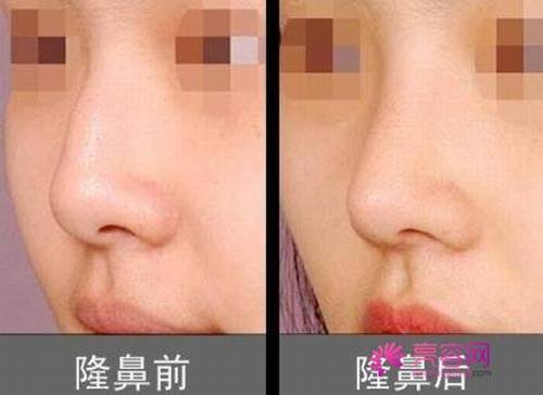 自体软骨隆鼻优势怎么样价格案例