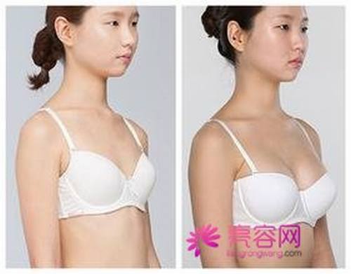 来聊聊女性都十分关注的话题：隆胸后是否可以哺乳！？