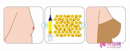 胸小的妹子看过来！自体脂肪移植丰胸原理介绍！自体脂肪丰胸后减肥会变小吗？！会不会反弹呢？！