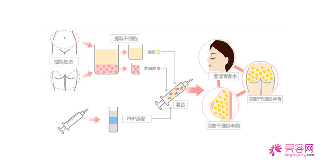 你知道自体脂肪隆胸吗？自体脂肪隆胸要点总结（一）