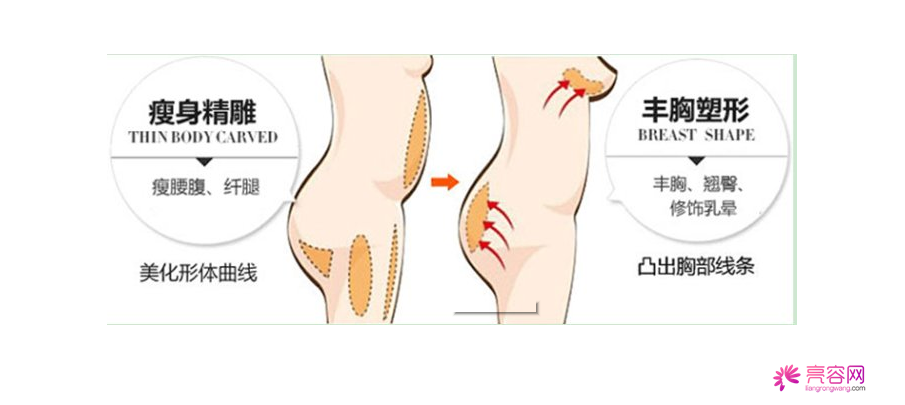 你知道自体脂肪隆胸吗？自体脂肪隆胸要点总结（二）