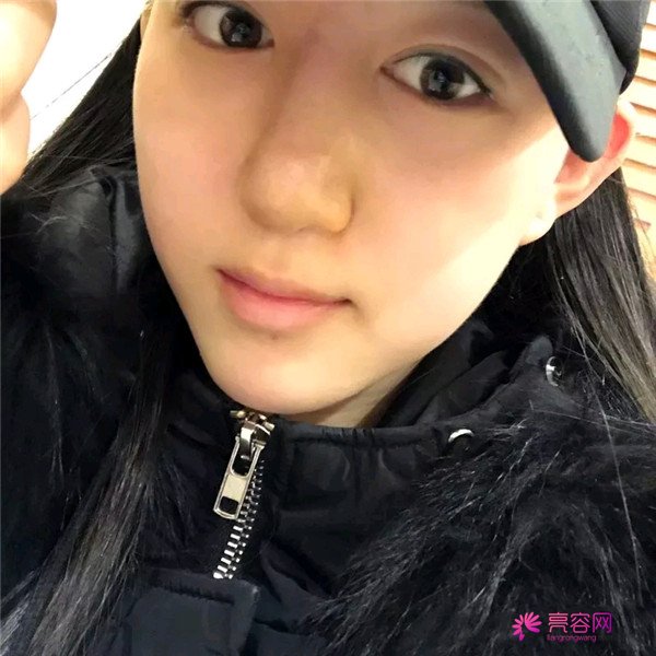 小仙女儿的鼻部手术案例分享连载（一）