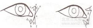 眼角开大术是怎么形成的_开眼角介绍