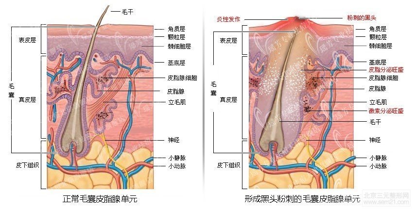 激光祛痘介绍