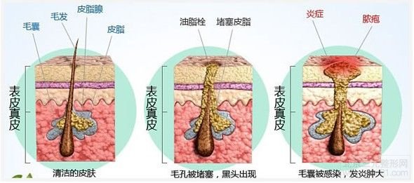 光子祛痘是怎样的？