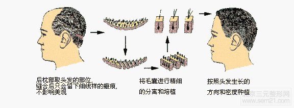 植发术