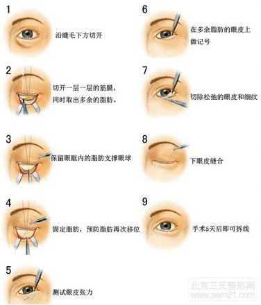 外切法和激光去眼袋