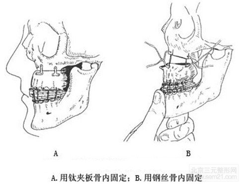 地包天手术危险吗？有副作用吗？多少钱？