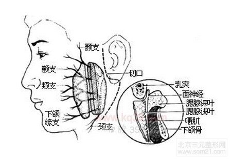 下颌角切除术有风险吗？有什么副作用？多少钱