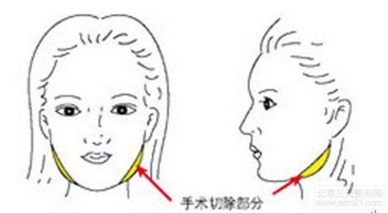 咬肌肥大缩小术有副作用吗？维持多久时间？有