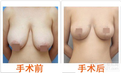 乳房下垂矫正手术果好吗，价格多少钱？