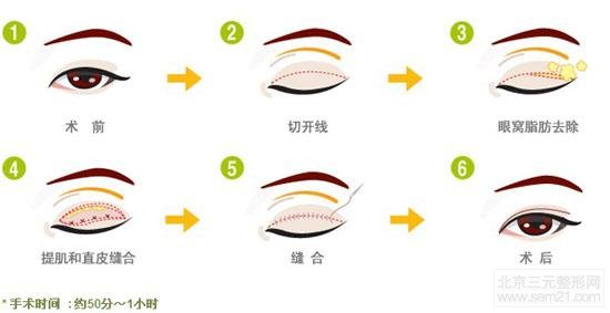 韩国全切双眼皮过程