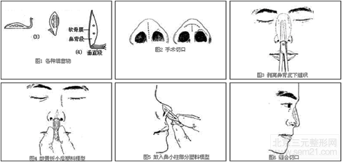 韩国矮鼻矫正（假体）多少钱？怎么样？