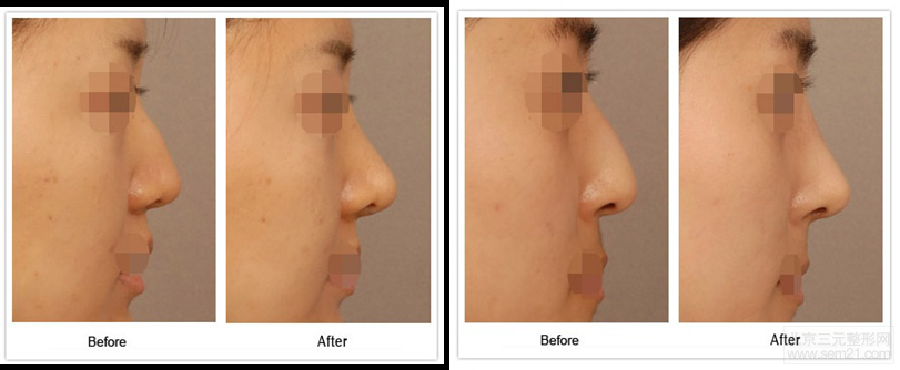 韩国鹰钩鼻矫正手术方法，矫正案例。