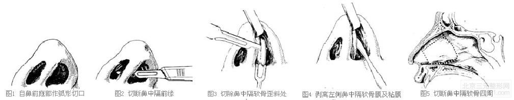 韩国歪鼻矫正手术方法？价格多少钱？