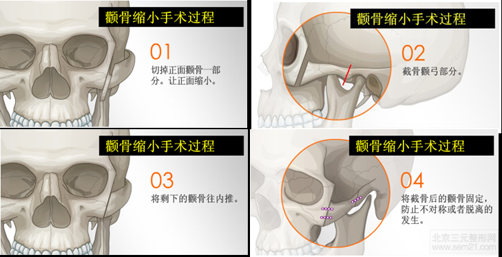 韩国颧骨缩小手术做得怎么样？