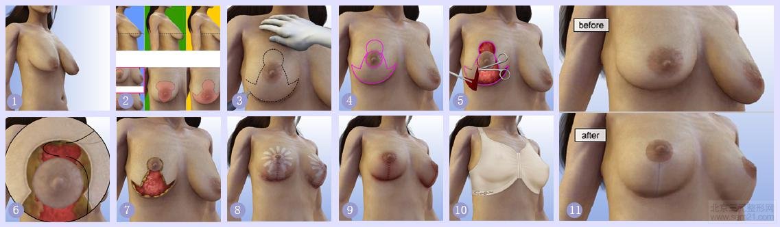 韩国乳房下垂提升手术【过程、案例图、副作用