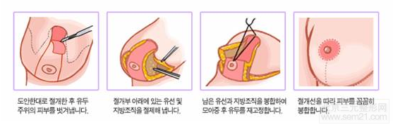 韩国乳房下垂提升手术【过程、案例图、副作用