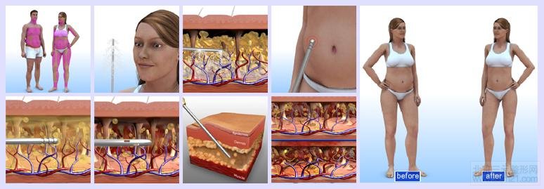 韩国吸脂减肥手术方法，过程和术后手术恢复表