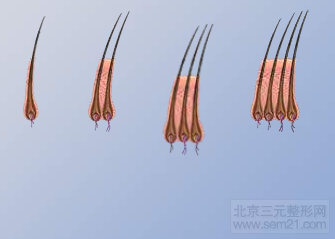 韩国毛发移植优势和术后注意事项