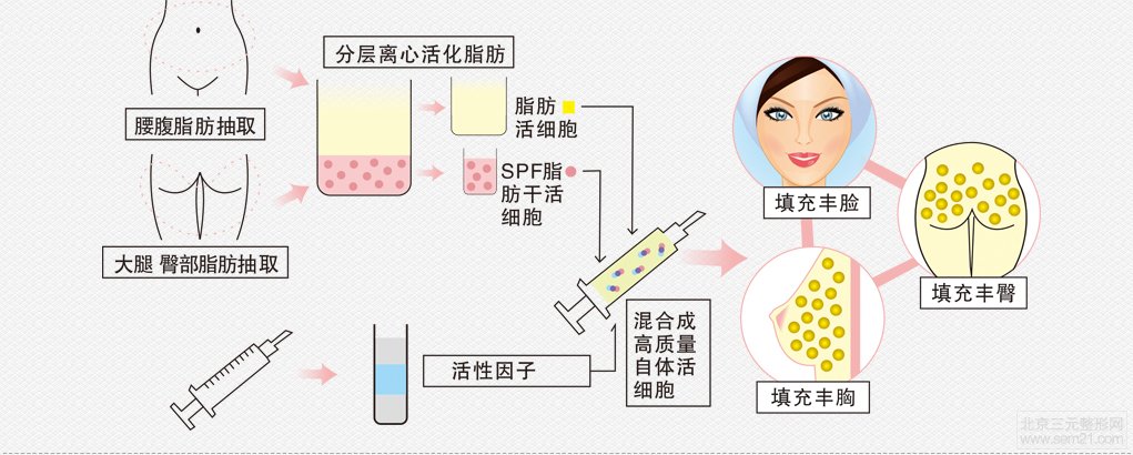 广州军美王世虎自体脂肪移植价格？果怎么样