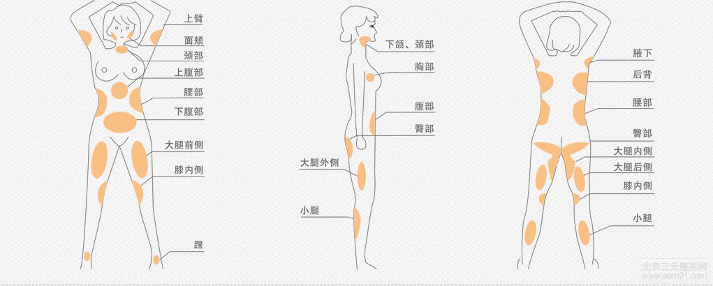 广州军美整形医院王世虎吸脂减肥价格？多少钱