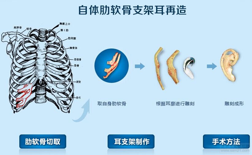 上海东方丽人吴建明耳朵再造怎么样？果好吗