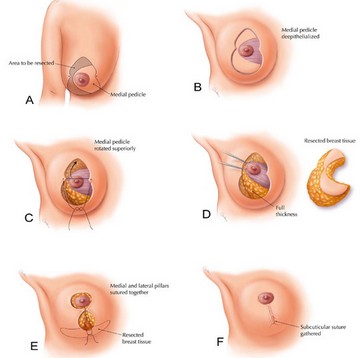 乳头缩小术