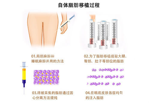 自体脂肪移植脂肪的成活率是多少？