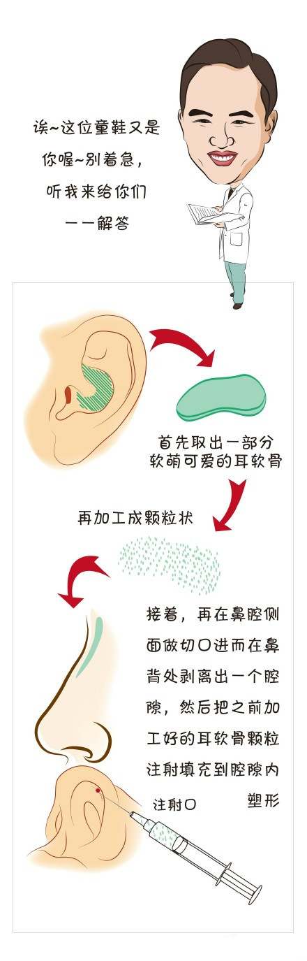 什么是自体颗粒注射隆鼻？