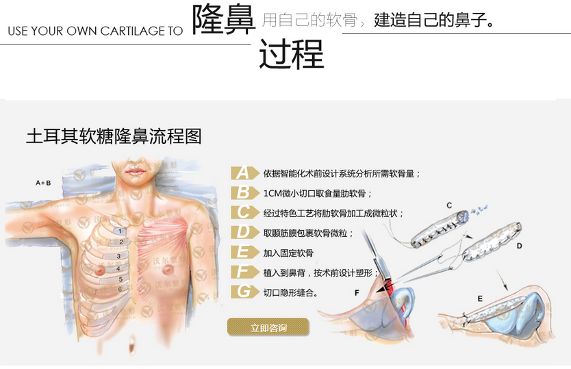 刘彦军土耳其软糖隆鼻怎么样？价格