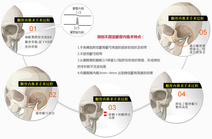 上海名航俞良钢磨颧骨多少钱？好吗？