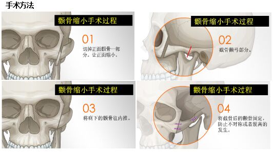 磨颧骨整形手术后会下垂吗？