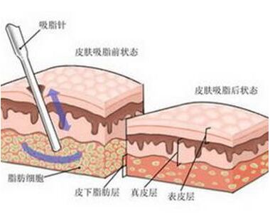 北京三元网-溶脂和吸脂的区别