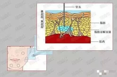 北京三元网-溶脂和吸脂的区别