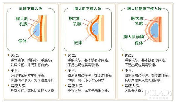 哈医大一院孙延昌隆胸怎么样？评价