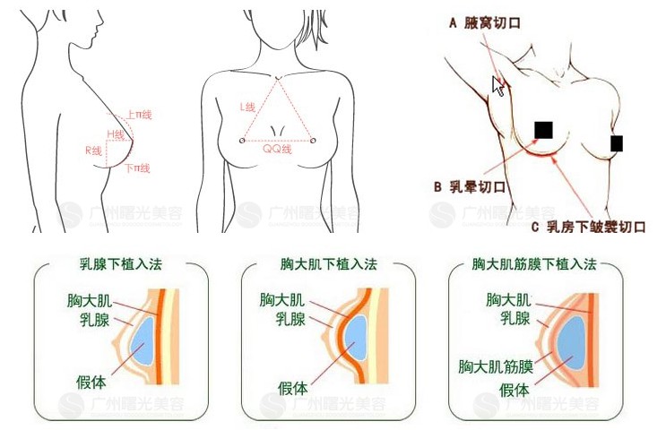 假体隆胸切口不是所有人都适合的