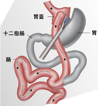 健康的减肥是节食、运动还是吸脂减肥