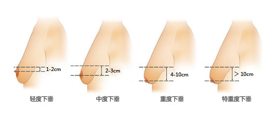 北京三元网讲解乳房下垂整形方法