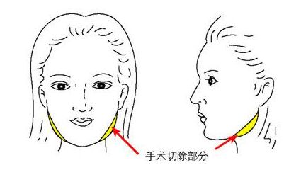 颧骨整形手术下垂解决办法