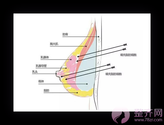 上海华美整形邓守成隆胸怎么样？有没有案例？