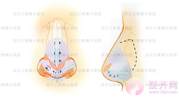 北京米扬丽格巫文云隆鼻失败修复怎么样？有没