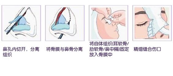 为什么现在临床推广的只有自体软骨隆鼻