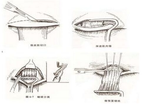 上睑下垂会带来诸多疾病-需重视