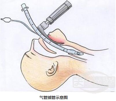 下颌角磨骨是局麻好还是全麻好