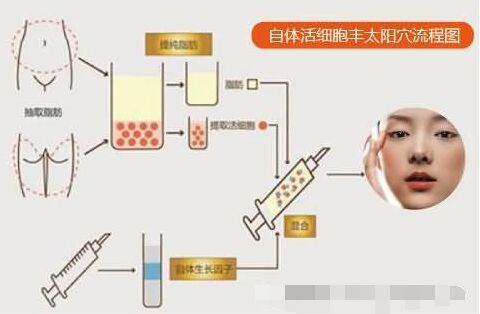 说说自体脂肪和玻尿酸丰太阳穴