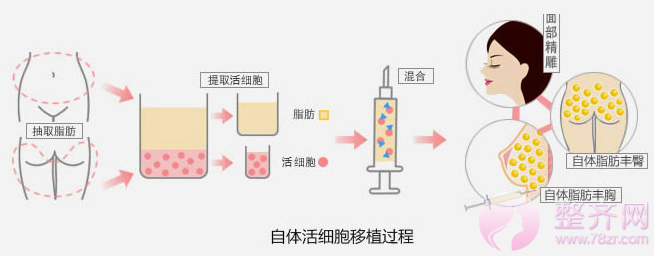 成都恒博李烈自体脂肪填充怎么样？多少钱？