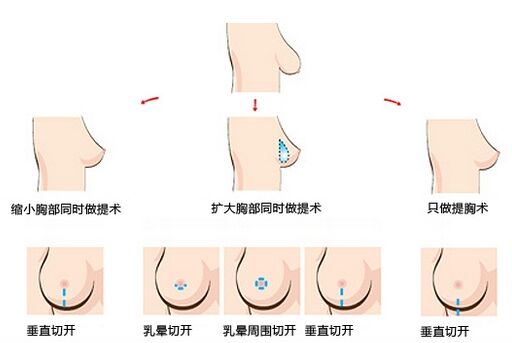 长沙乳房下垂矫正手术方法