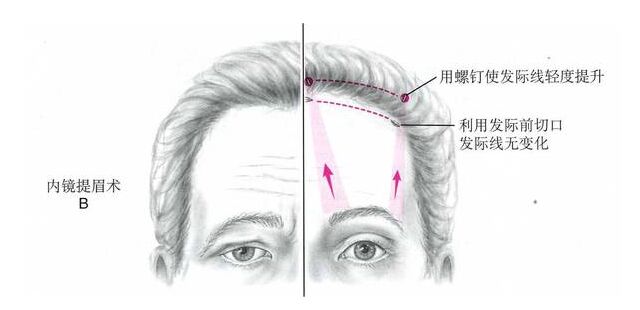 内窥镜除皱技术的优缺点