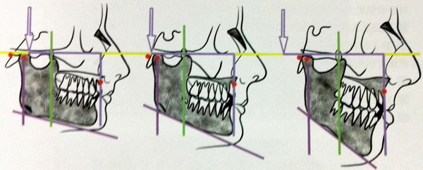 如何诊断是否需要做下颌角整形手术